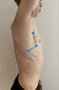 A person's right lateral chest naked, with blue dots outlining the patter of auscultation.