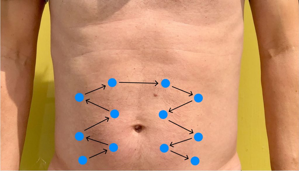 A person's naked abdomen demonstrating the pattern of percussion starting with a blue dot in the right lower quadrant and using a zig zag pattern moving up, across and down to the left lower quadrant.