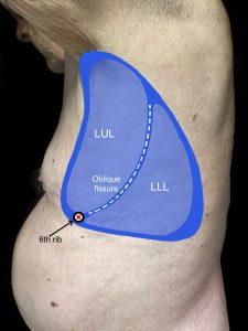 A man's left lateral chest with lungs, including lobes and landmarks drawn onto image and noted.
