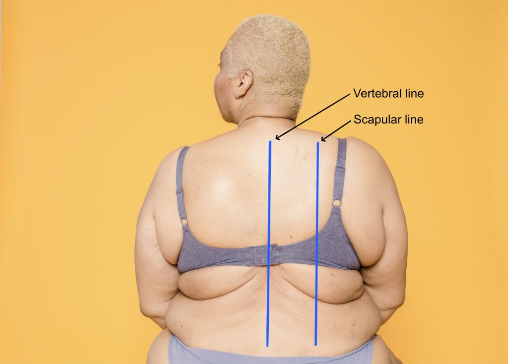 A woman's posterior chest with the vertebral and scapular lines noted.