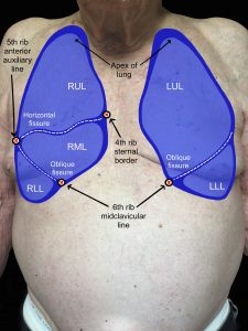 A man's anterior chest with lungs, including lobes and landmarks drawn onto image and noted.