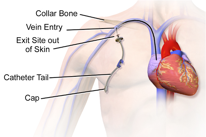 Central line placement in the body. The catheter enters a major vein just below the right collarbone and travels into the heart, ending in the right atrium. The catheter tail and its cap are visible outside the body at the exit site.