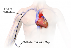 Diagram of a peripheral line's placement in the body. This catheter enters a major vein in the right arm above the elbow, and ends higher up in the vein. The catheter end does not reach the heart. The catheter tail and cap are visible outside the body at the point of entry.