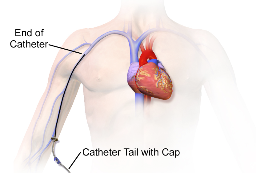 A peripheral line catheter enters a major vein in the right arm above the elbow, and ends higher up in the vein. The catheter end does not reach the heart. The catheter tail and cap are visible outside the body at the point of entry.
