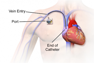 Diagram of a Venous Access Port Catheter (also called a portacath) placed in the body. The catheter enters the body near the right collarbone, travels up a major vein and ends in the right atrium of the heart. The port is visible as a small bump under the skin.