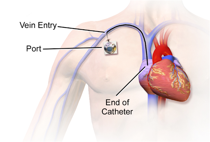 A catheter in a venous access port