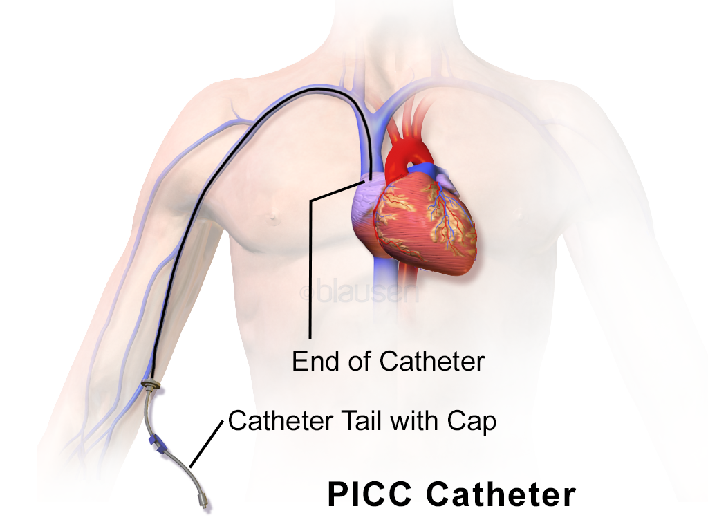 PICC is inserted into a major vein in the upper right arm, just above the inner elbow. It travels up through the vein and ends in the right atrium of the heart. The catheter tail and its cap are seen outside the body at the point of insertion.