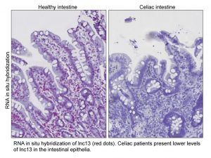 Comparison of RNA in situ hybridization in both healthy intestine and celiac intestine