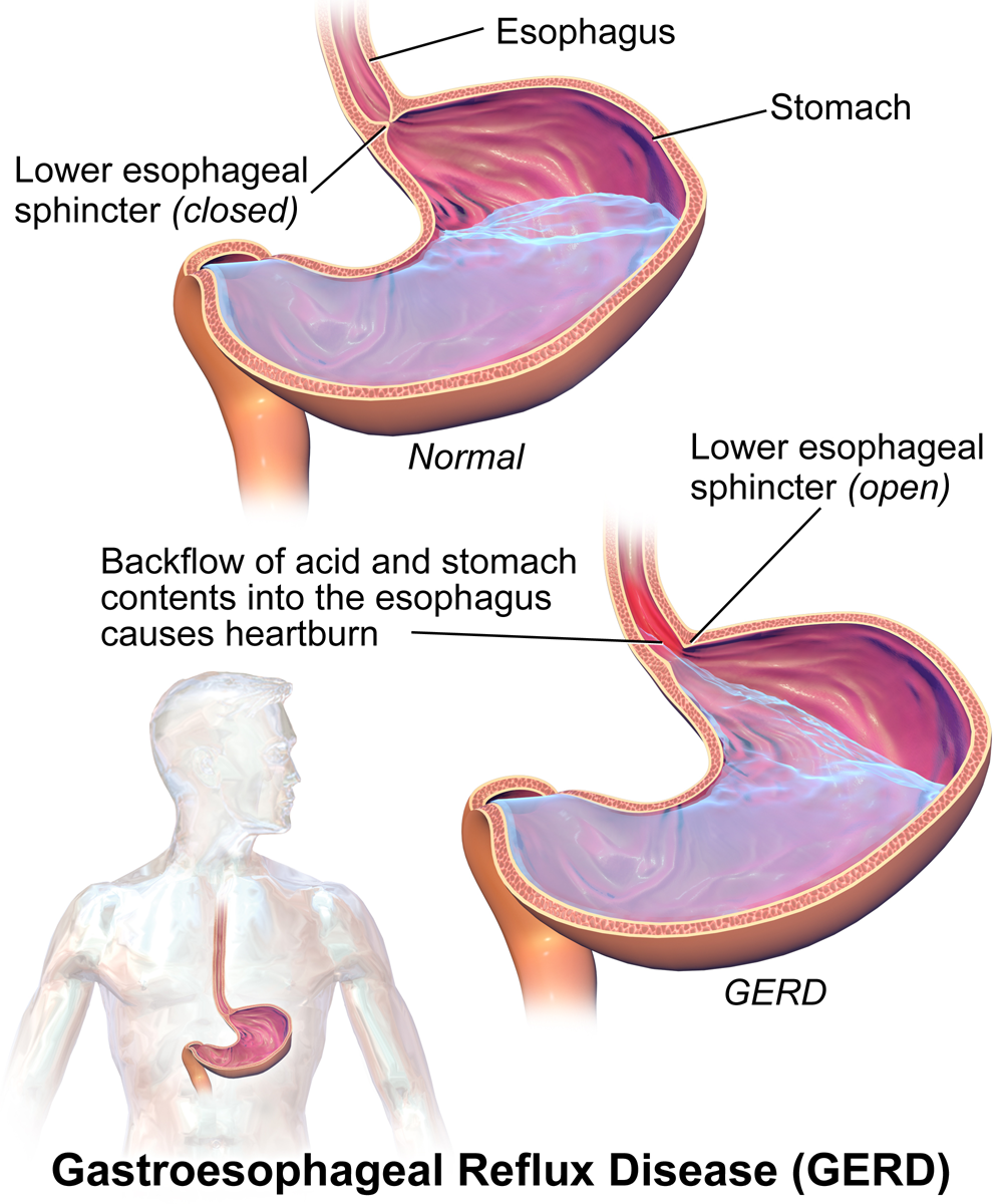 Diagram comparing a normal upper GI tract to one (top) with gastroesophageal reflux disease (bottom)