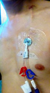 A two-lumen catheter is inserted on the patient's left side. Full text description is in a corresponding paragraph.
