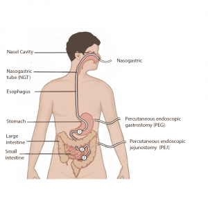 Three types and placements of enteral feeding tubes are shown. 1. A nasogastric tube (NGT) is placed up the nose into the nasal cavity, and continues down the esophagus before ending in the stomach. 2. A percutaneous endoscopic gastrostomy (PEG) tube is placed through the skin of the upper abdomen into the stomach. 3. A percutaneous endoscopic jejunostomy (PEJ) tube is placed through the lower abdomen and into the jejunum of the small intestine.