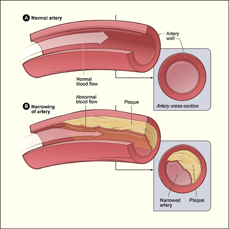 Illustration comparing an artery with normal blood flow (top) to one with abnormal blood flow due to plaque build-up along the artery wall, resulting in a narrowed artery (bottom).