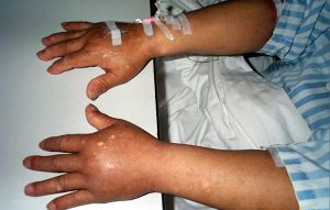 A person's arms are outstretched, palm-down. Both arms are moderately swollen, an indication of fluid build-up (edema).