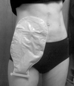 An ileostomy bag lies flat covering a stoma on the right side of a woman's abdomen.