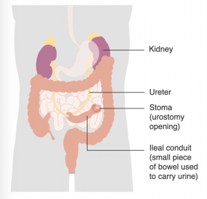 The ureter is attached to a small piece of bowel called an ileal conduit. The ileal conduit carries urine out of the body through an opening called a stoma in the abdomen.