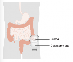 A colostomy bag attaches to a stoma on the left side of the abdomen, leaving a rectal stump.