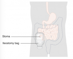 An ileostomy bag covers the stoma on the right side of a person's abdomen.