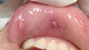 Two ulcers on the labial mucosa of the upper lip